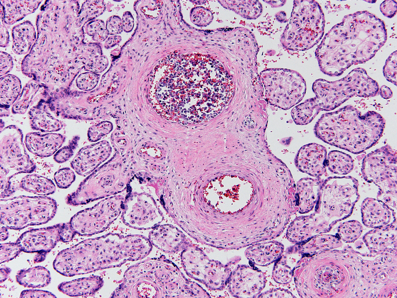 Low power evaluation (100X, H&E) reveals a population of mononuclear cells within chorionic vessels